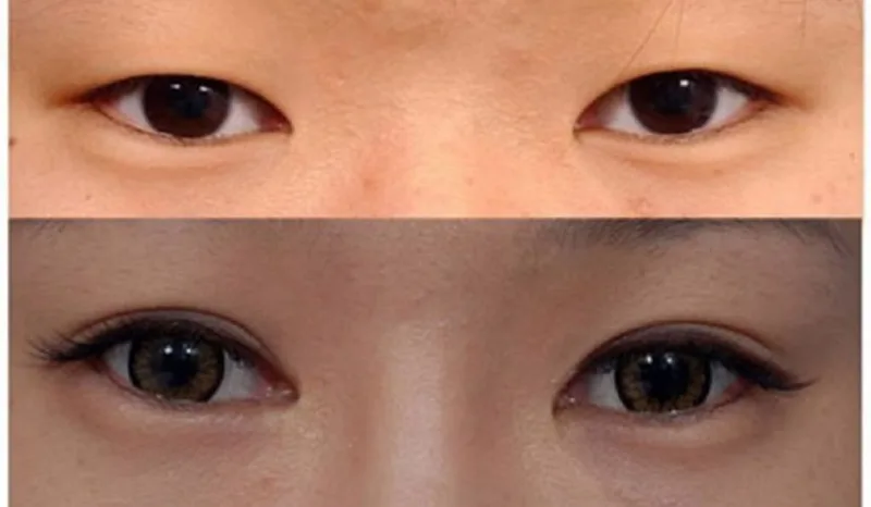The Truth About Double Eyelid Surgery in China